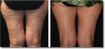 Cellulite Reduction - Coquitlam Medical Laser