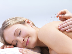 Acupuncture at Apex Chiropractic Coquitlam.